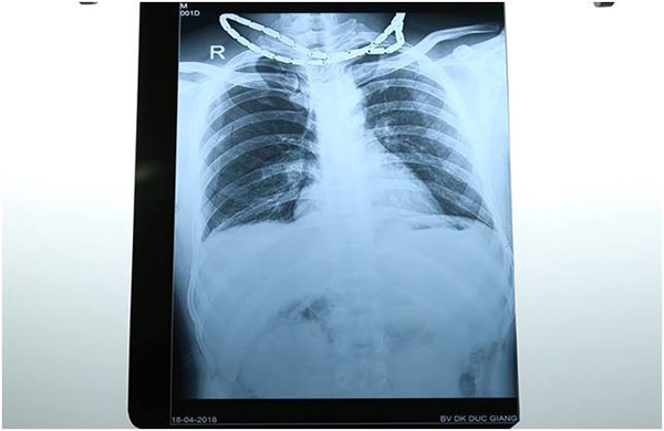Bị nhiều vết thương thấu bụng, thấu ngực do tai nạn sinh hoạt